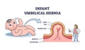 Infant umbilical hernia as painless lump near belly button outline diagram