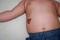 Infantile Hemangioma red birthmark on the baby`s belly