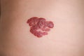 Infantile Hemangioma red birthmark on the baby`s belly Royalty Free Stock Photo