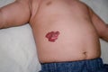 Infantile Hemangioma red birthmark on the baby`s belly