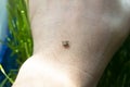 Infected dangerous biting tick on human skin Royalty Free Stock Photo
