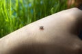 Infected dangerous tick on human skin - a carrier of infections and viruses Royalty Free Stock Photo