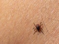 Infected female deer tick on hairy human skin. Ixodes ricinus. Parasitic mite. Acarus. Dangerous biting insect on background of