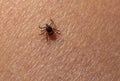 Infected female deer tick on hairy human skin. Ixodes ricinus. Parasitic mite. Acarus. Dangerous biting insect on background of Royalty Free Stock Photo