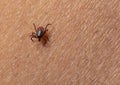 Infected female deer tick on hairy human skin. Ixodes ricinus. Parasitic mite. Acarus. Dangerous biting insect on Royalty Free Stock Photo