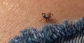 Infected female deer tick on hairy human skin. Ixodes ricinus. Parasitic mite. Acarus. Dangerous biting insect on
