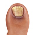 Infected Fungal Toe Nail Royalty Free Stock Photo