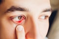 Infected sty barley purulent eye. Man pulls down lower eyelid showing inflammation pus caused by Staphylococcus Royalty Free Stock Photo