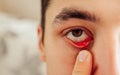 Infected sty barley purulent eye. Man pulls down lower eyelid showing inflammation pus caused by Staphylococcus Royalty Free Stock Photo