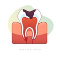 Infected Teeth - Root Canal Treatment - Stock Illustration