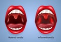 Infected Tonsils Inflammation Vector Concept