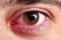 Infection in the eye, bursting vessels of the eye Royalty Free Stock Photo