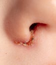 Infection on the nose of the child