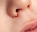 Infection on the nose of the child