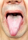 Infection tongue