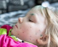 An infectious disease in a little girl, chickenpox on her face. Treatment of the herpes virus, chickenpox Royalty Free Stock Photo