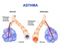 Inflamation of the bronchus causing asthma Royalty Free Stock Photo