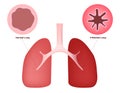 Inflame lung Royalty Free Stock Photo