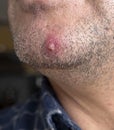 inflamed acne on the facial skin of a person, single large acne on the face