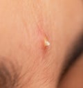 Inflamed acne on the skin of the face