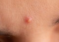 Inflamed acne on the skin of the face