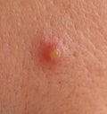 Inflamed acne on the skin of the face