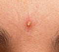 Inflamed acne on the skin of the face