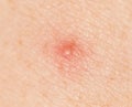 Inflamed acne on the skin