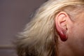 Inflamed earlobe after ear piercing Royalty Free Stock Photo