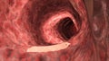 An inflamed colon