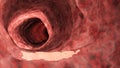 An inflamed colon