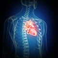 An inflamed heart Royalty Free Stock Photo