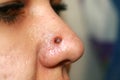 Inflamed pimple on nose. Cyst Acne. Acne on the skin