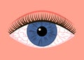 Inflamed sick eye with allergy symptom red veins. Eye fatigue or allergic conjunctivitis infection. Vector illustration