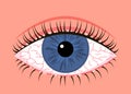 Inflamed sick human eye with blepharitis, allergy symptom red veins. Eye disease, fatigue or allergic conjunctivitis