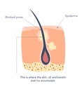 Inflamed skin around the hair follicles, 1st stage