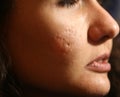 Inflamed skin of the face in pimples and acne. Keloid scars from acne