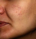 Inflamed skin of the face in pimples and acne. Keloid scars from acne