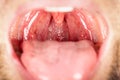 Inflamed throat of a person affected by an infection very close-up