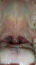 Inflamed uvula