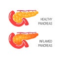 Inflames pancreas concept. Vector illustration Royalty Free Stock Photo