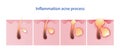 Inflammation acne process vector illustration isolated on white background. Royalty Free Stock Photo