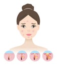 Inflammation acne process on woman face vector illustration on white background. Royalty Free Stock Photo