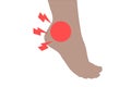 Inflammation of the ankle,