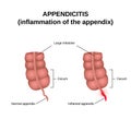 Inflammation of the appendix