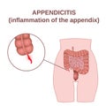 Inflammation of the appendix