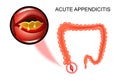 The inflammation of the Appendix