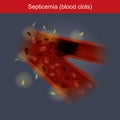 Septicemia. Info graphic. Royalty Free Stock Photo