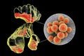 Inflammation of frontal, maxillary, and ethmoid sinuses and close-up view of staphylococcal bacteria