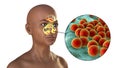 Inflammation of frontal and maxillary sinuses and close-up view of pneumococci bacteria